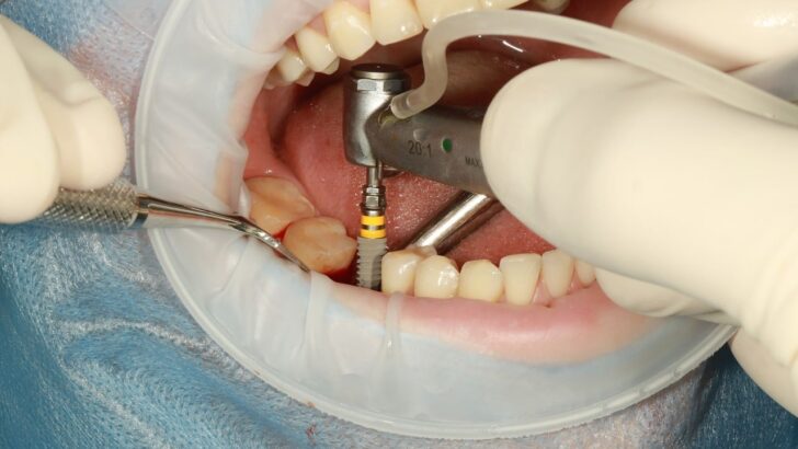 La mutuelle santé, rembourse t-elle les implants dentaires ?